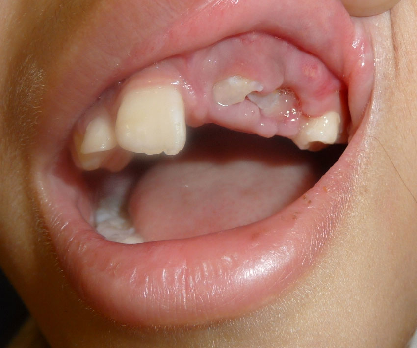 traumatismo dental