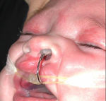 moldeador nasal